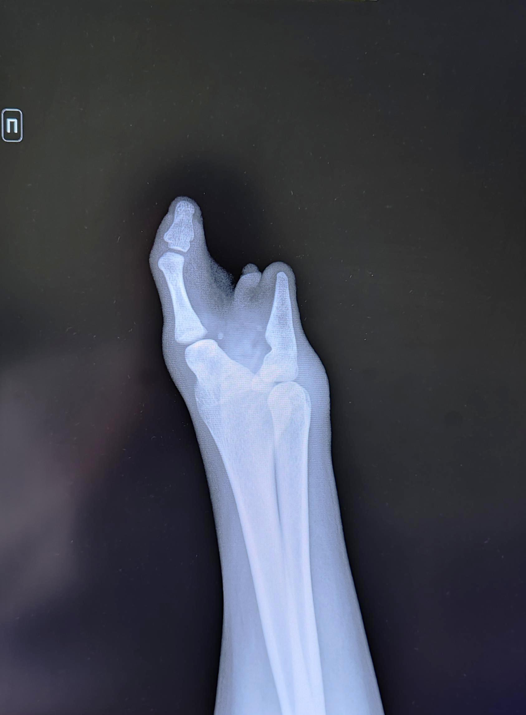 Congenital malformation of the hand - symbrachydactyly - My, The medicine, Bones, Brush, Army, Traumatology, Orthopedics, X-ray, Radiology, Longpost, Conscripts, Conscription