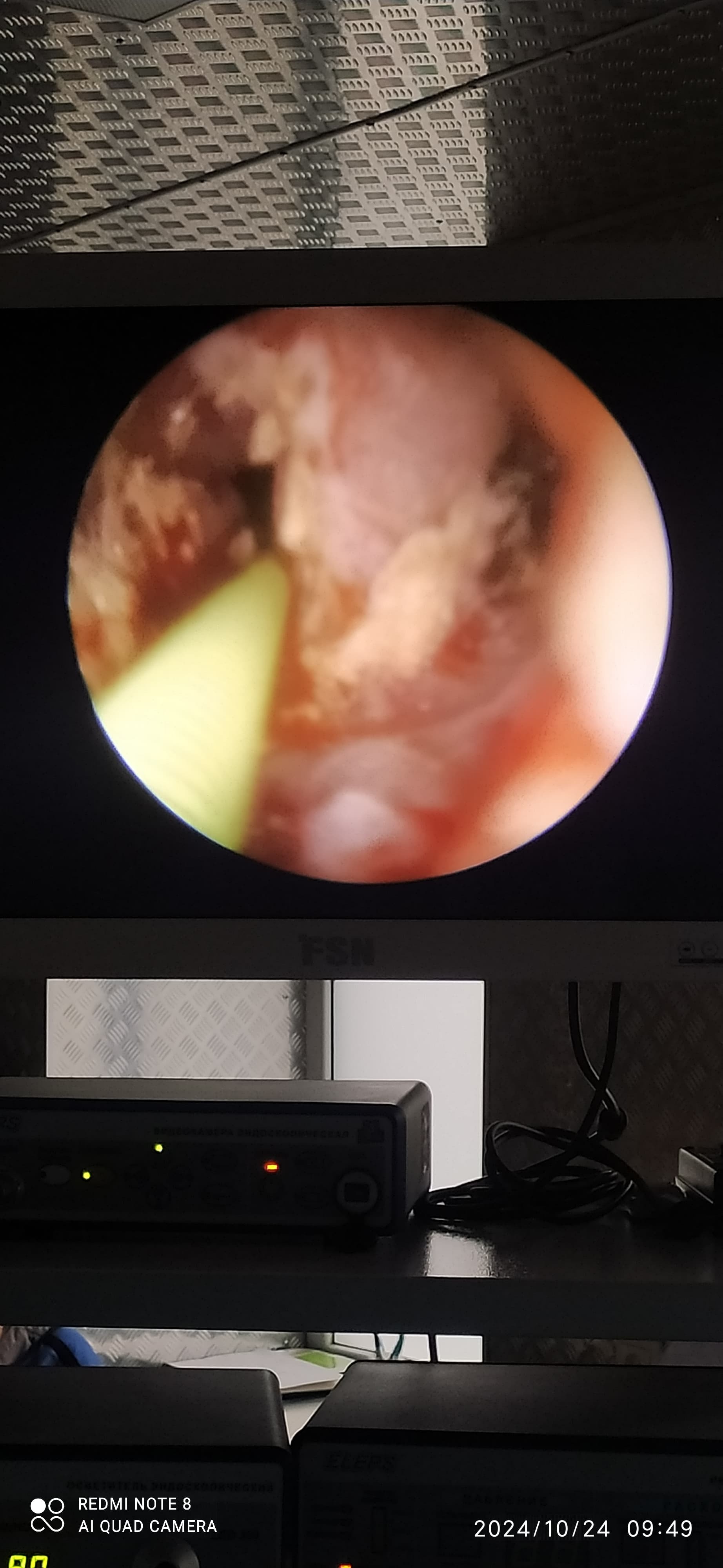 Removal of ureteral stone - My, The medicine, Treatment, Doctors, Health, Disease, Urology, Urologist, Longpost