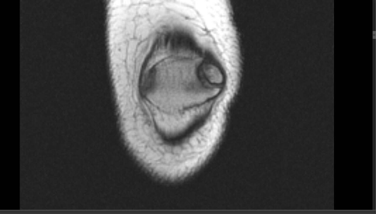 Bipartite patella - My, MRI, The medicine, Radiology, Traumatology, Longpost