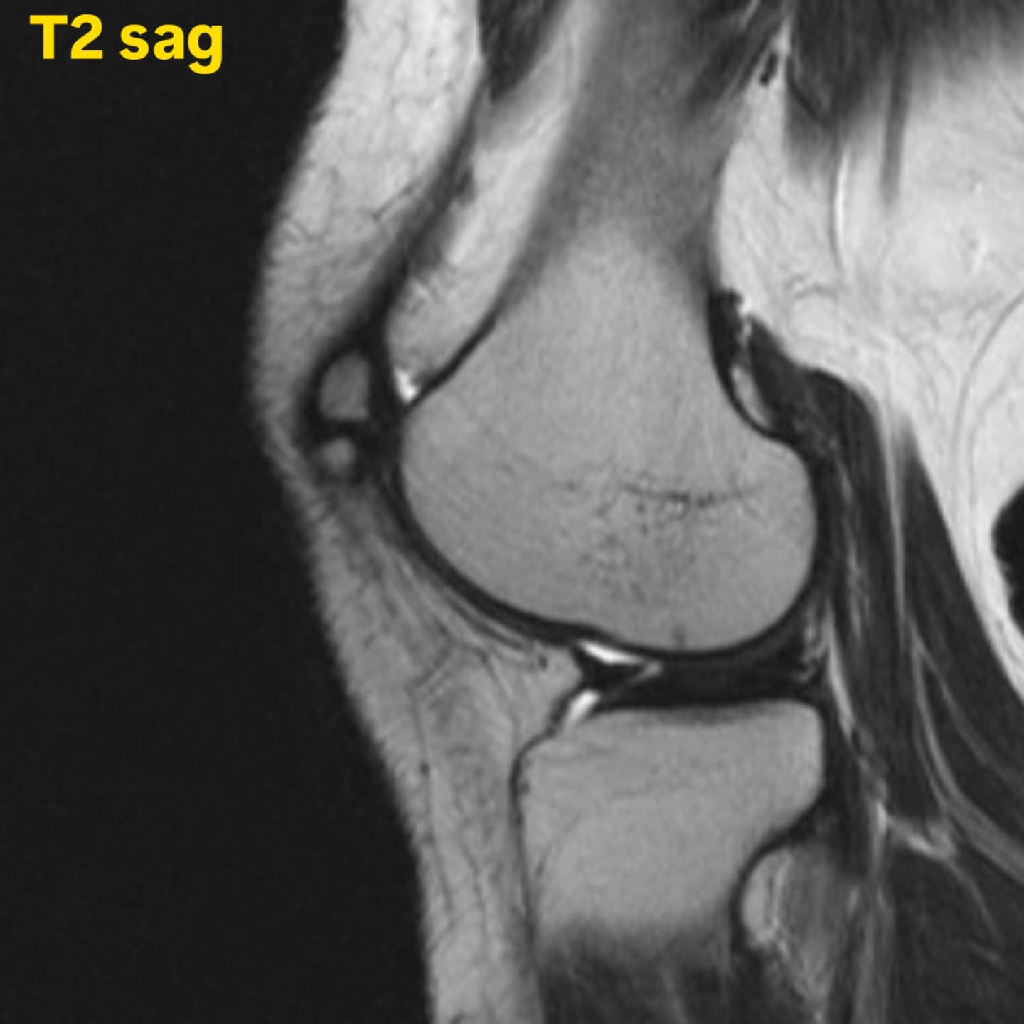 Bipartite patella - My, MRI, The medicine, Radiology, Traumatology, Longpost