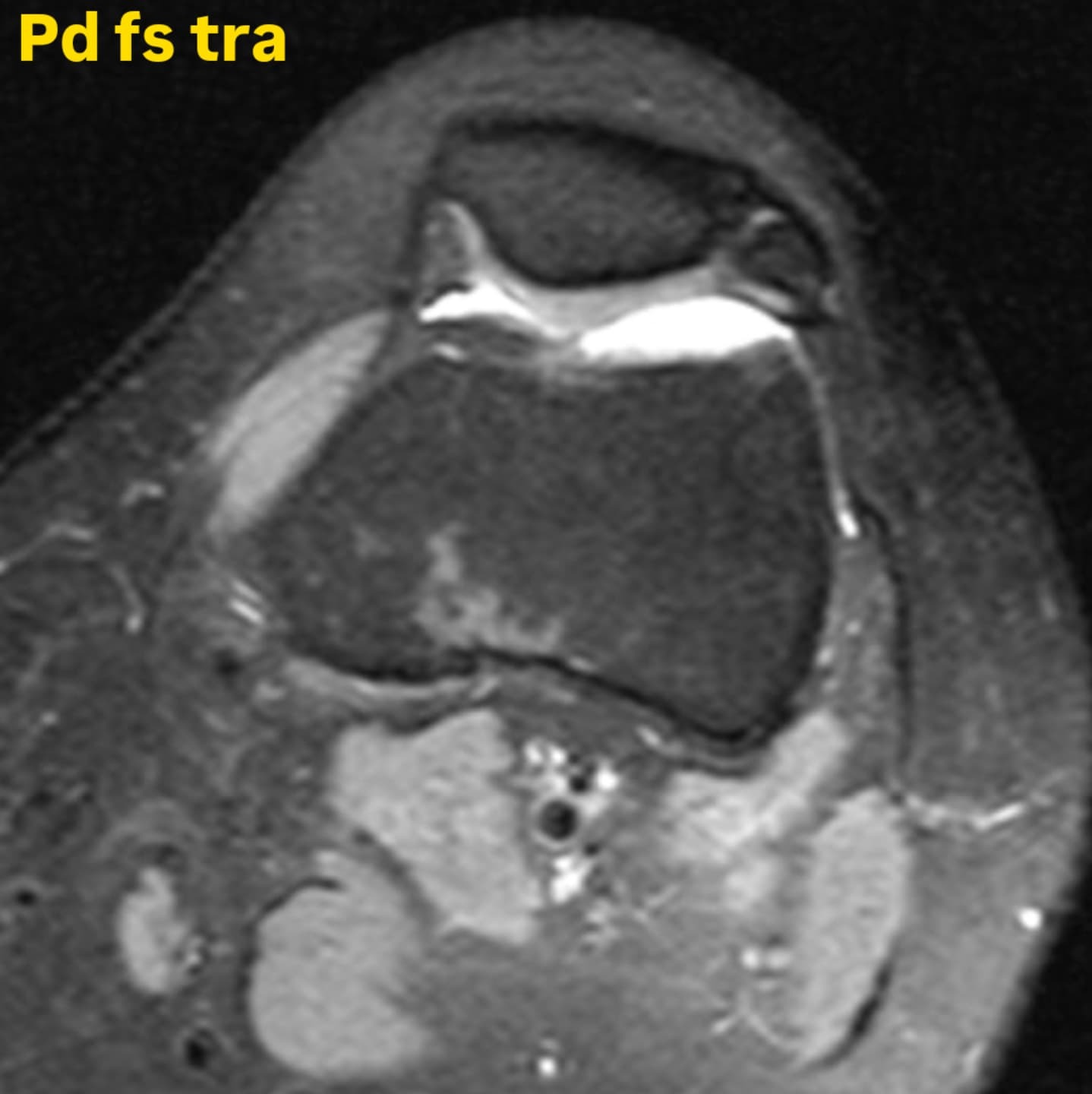 Bipartite patella - My, MRI, The medicine, Radiology, Traumatology, Longpost