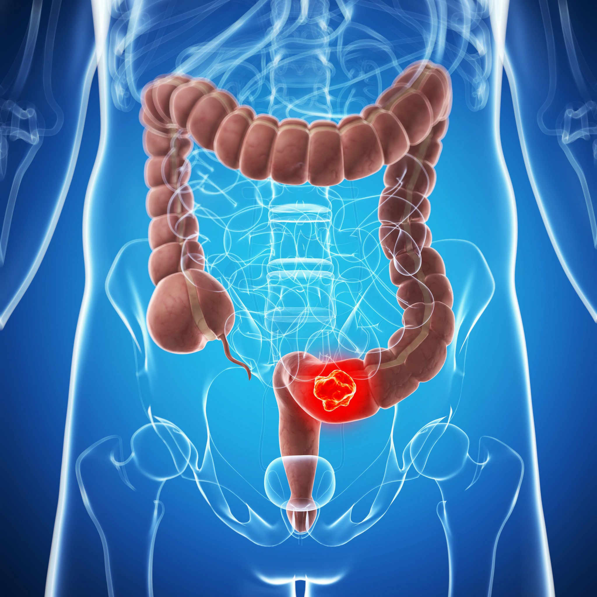 Total Colonoscopy: How We Found a Second Colon Tumor - Cancer and oncology, The medicine, Doctors, Disease, Medications, Polyclinic, Bowel cancer, Disease history, Operation, Surgery, Health, A life, Telegram (link), Yandex Zen (link), Longpost