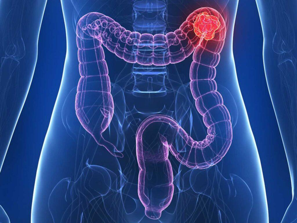 Total Colonoscopy: How We Found a Second Colon Tumor - Cancer and oncology, The medicine, Doctors, Disease, Medications, Polyclinic, Bowel cancer, Disease history, Operation, Surgery, Health, A life, Telegram (link), Yandex Zen (link), Longpost