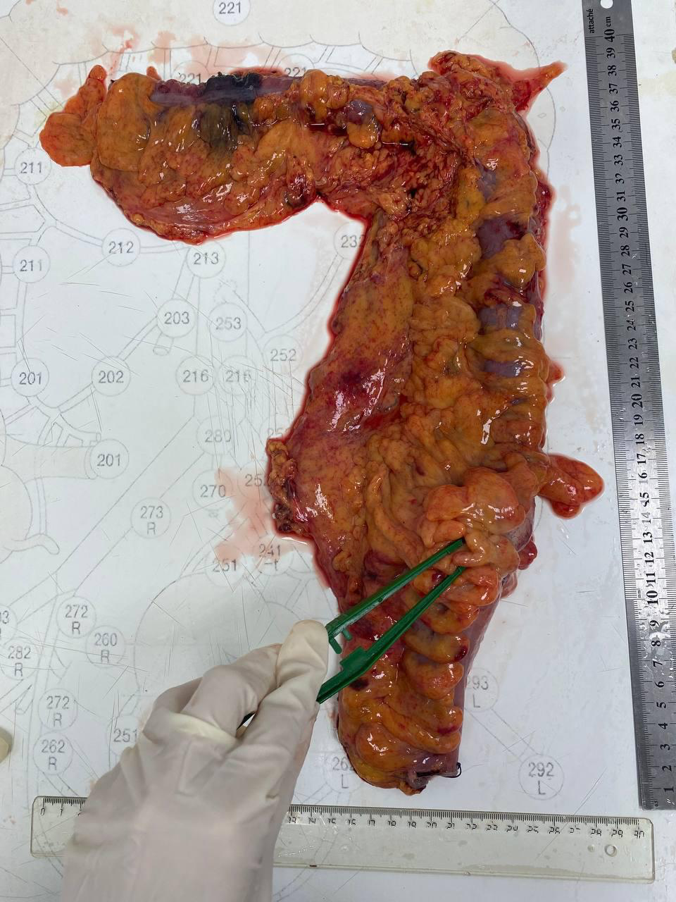 Total Colonoscopy: How We Found a Second Colon Tumor - Cancer and oncology, The medicine, Doctors, Disease, Medications, Polyclinic, Bowel cancer, Disease history, Operation, Surgery, Health, A life, Telegram (link), Yandex Zen (link), Longpost