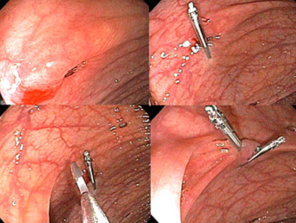 Clipping of bleeding vessels of the gastrointestinal tract - Treatment, Health, The medicine, Disease, Bleeding, Gastrointestinal tract, Ulcer, Endoscopy