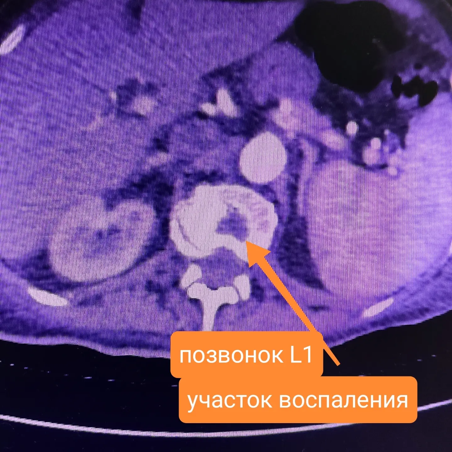 Follow your doctor's recommendations! - My, Recommendations, The medicine, Everything is running, Stroke, Atherosclerosis, Inflammation, Vertebrae, Nerves, Diagnosis, Neurology, Longpost