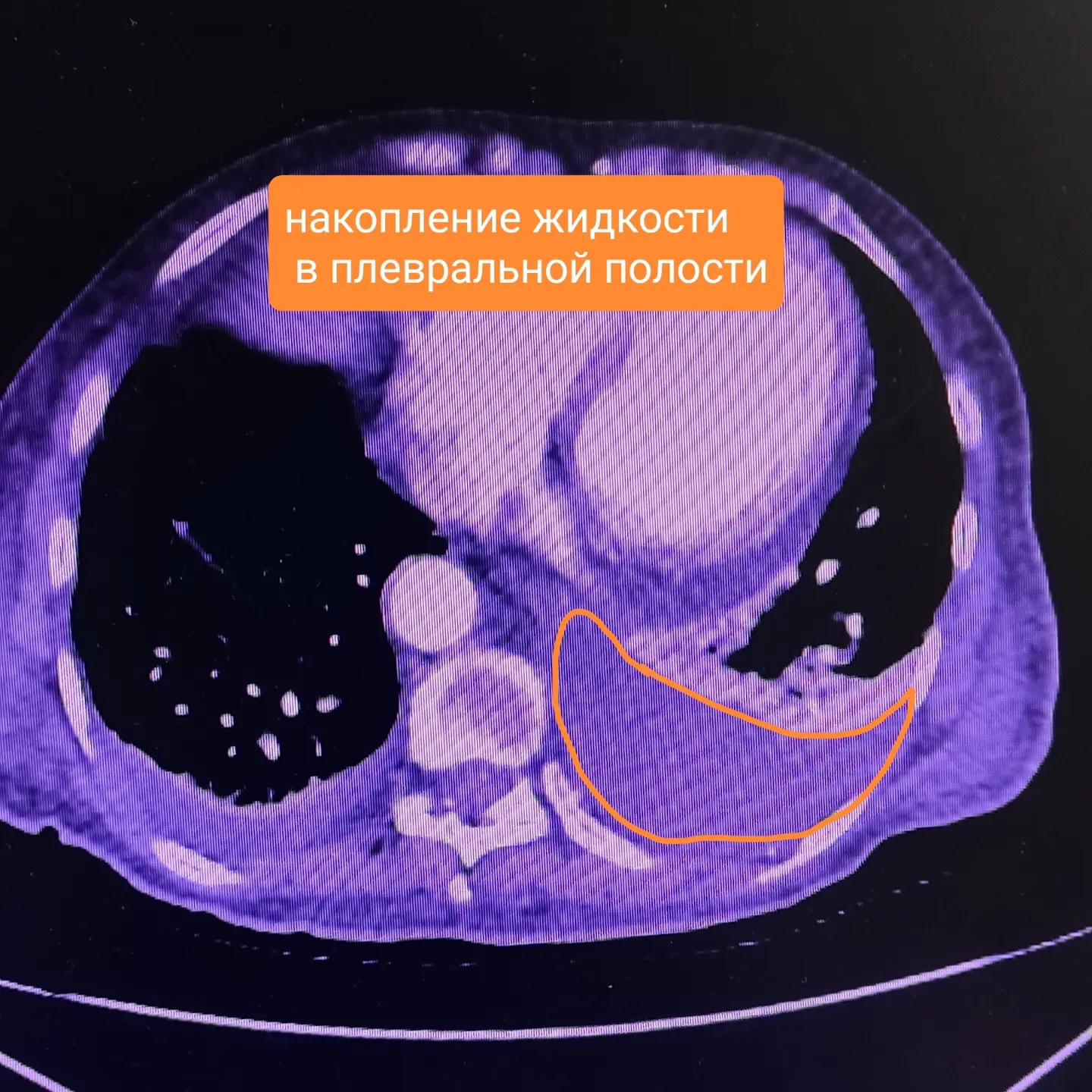 Follow your doctor's recommendations! - My, Recommendations, The medicine, Everything is running, Stroke, Atherosclerosis, Inflammation, Vertebrae, Nerves, Diagnosis, Neurology, Longpost