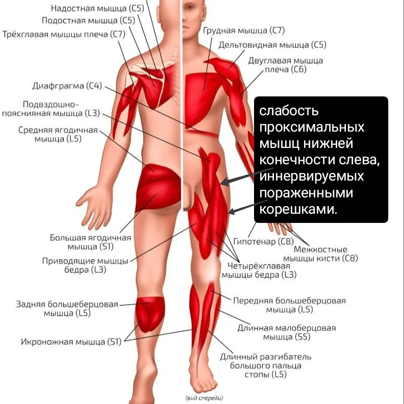 Follow your doctor's recommendations! - My, Recommendations, The medicine, Everything is running, Stroke, Atherosclerosis, Inflammation, Vertebrae, Nerves, Diagnosis, Neurology, Longpost