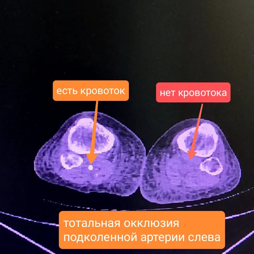 Follow your doctor's recommendations! - My, Recommendations, The medicine, Everything is running, Stroke, Atherosclerosis, Inflammation, Vertebrae, Nerves, Diagnosis, Neurology, Longpost