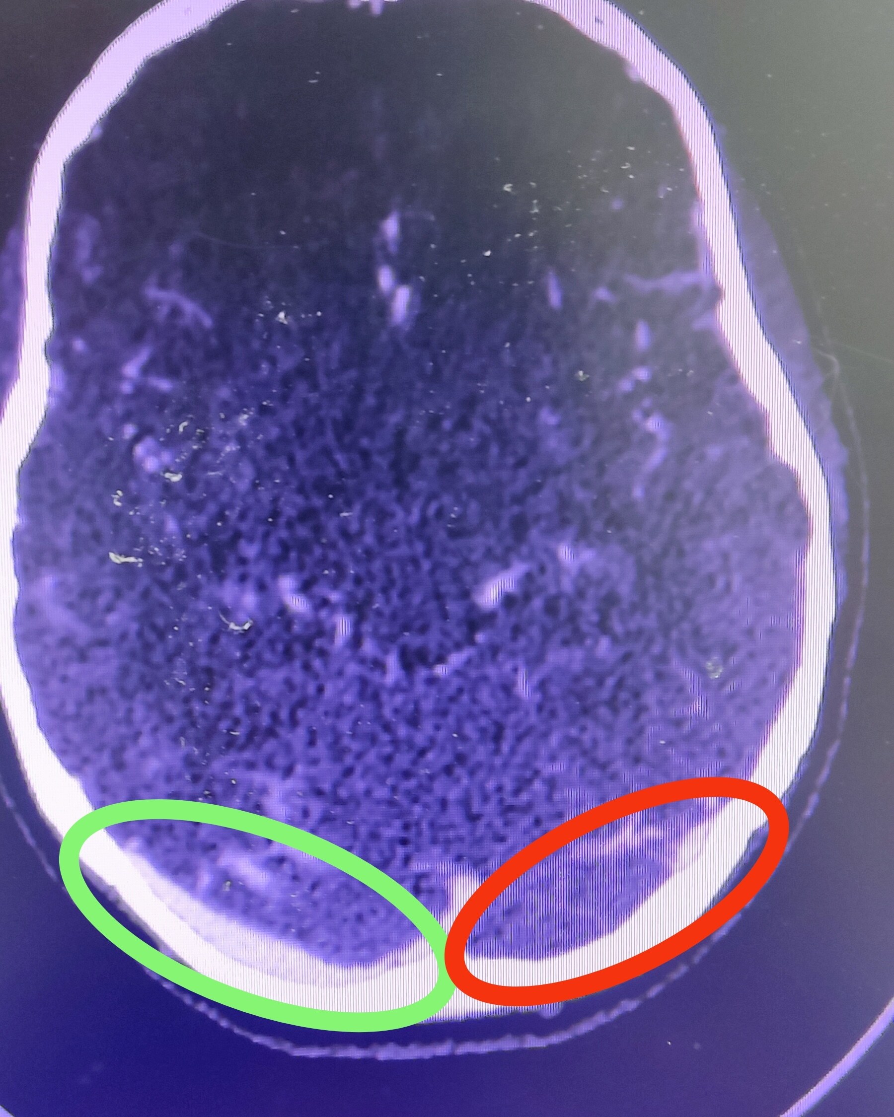 Meningitis. A case from medical practice - My, Neurology, Treatment, The medicine, Unusual, Diagnostics, Ambulance