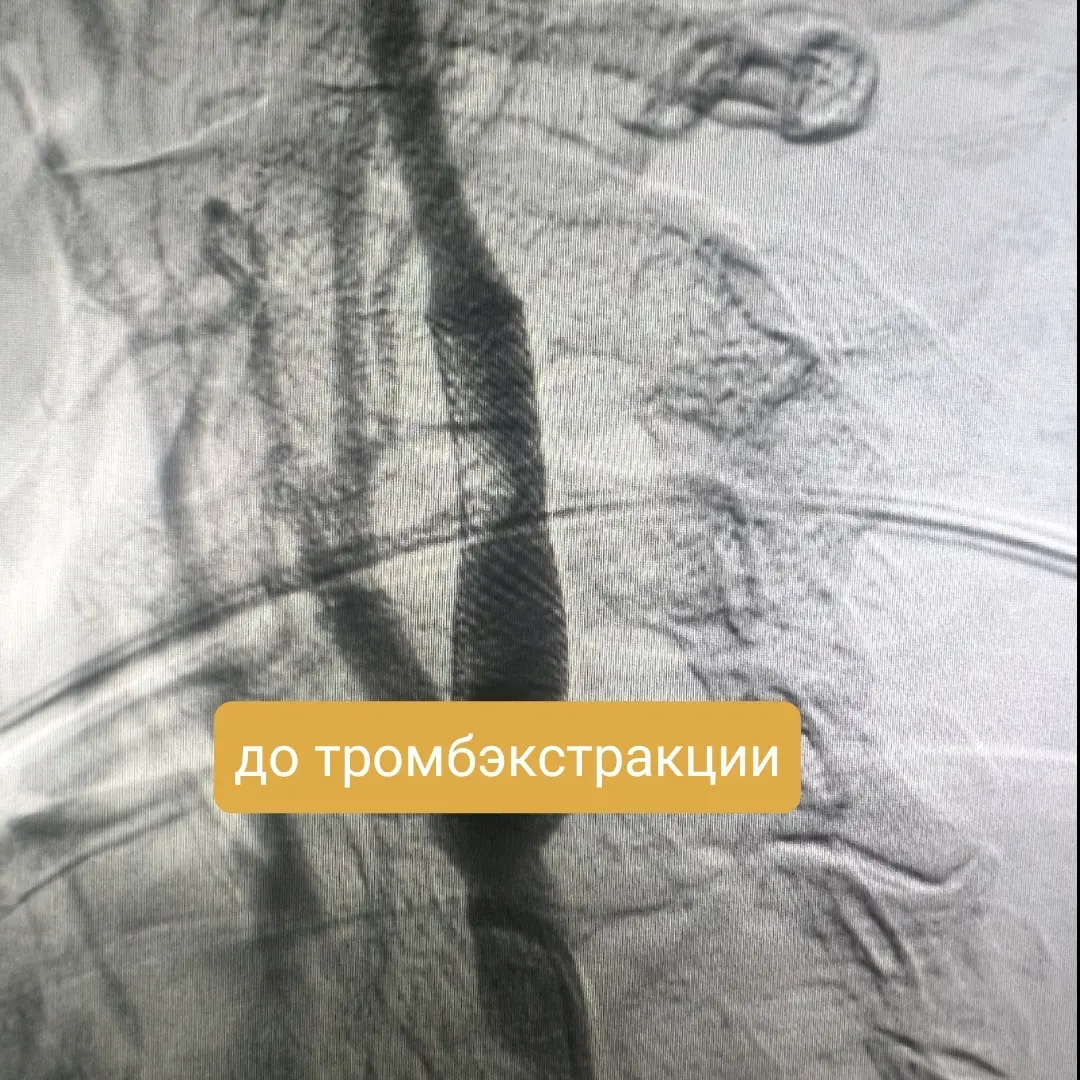 Думал, что само пройдет. Инсульт - Моё, Операция, Лечение, Лекарства, Медицина, Инсульт, Скорая помощь, Стентирование, Думал, Больница, История болезни, Длиннопост
