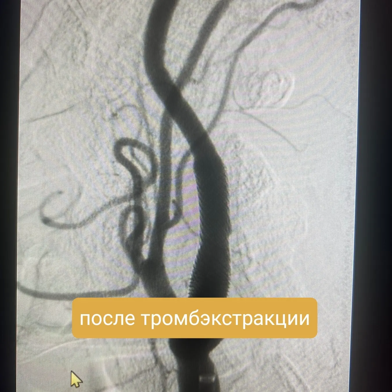 Думал, что само пройдет. Инсульт - Моё, Операция, Лечение, Лекарства, Медицина, Инсульт, Скорая помощь, Стентирование, Думал, Больница, История болезни, Длиннопост