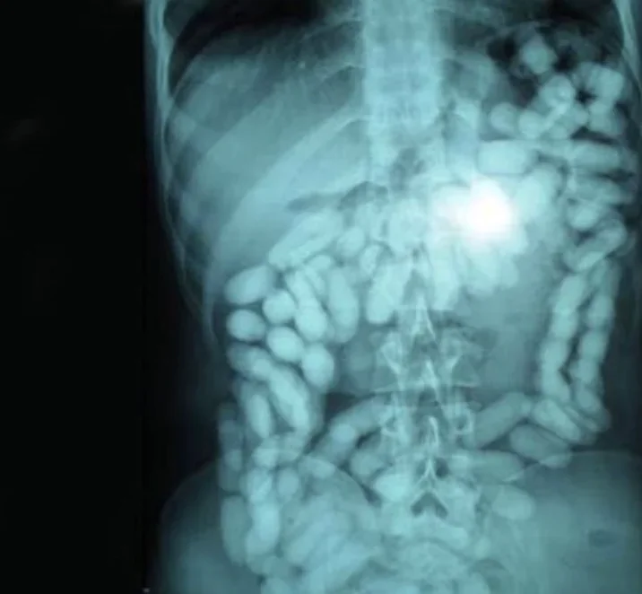 X-ray of a drug courier - X-ray, Courier, Prohibited Substances