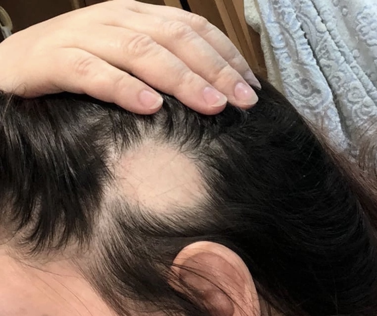 I go bald periodically - My, Hair, Problem, Need advice, Treatment, Alopecia areata