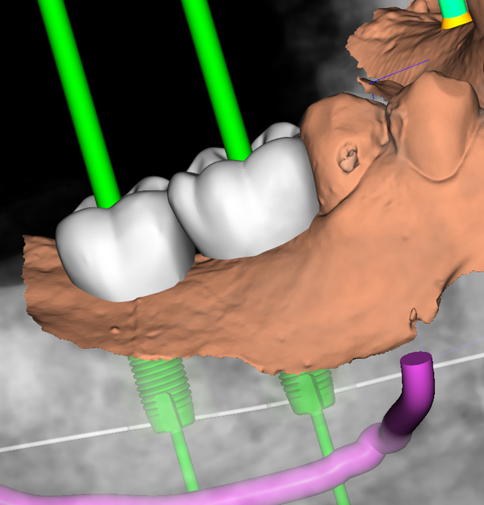 Saga of Dentistry. Chapter 99. Why can't a tooth and an implant be connected with a bridge? - My, Dentistry, The medicine, Doctors, Implants, Health, Prosthetics, Teeth, Crowns, Polyclinic, Work, Mechanics, Treatment, Problem, Dentist, Longpost