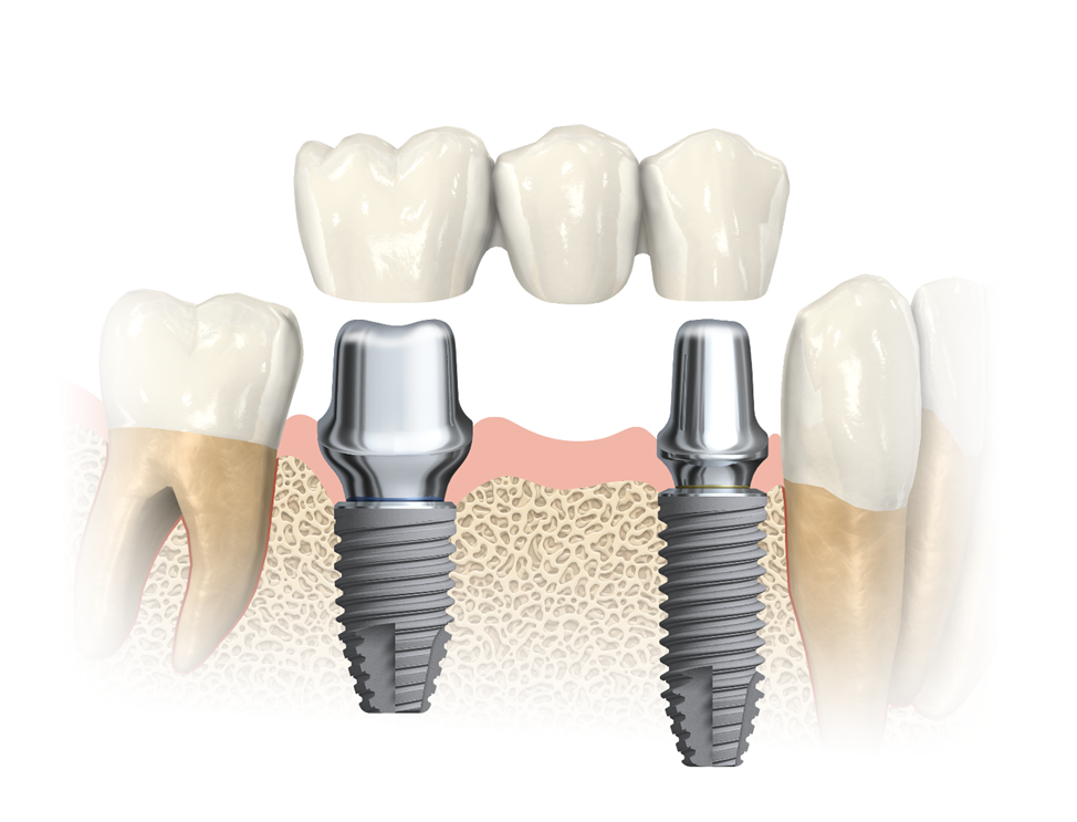 Saga of Dentistry. Chapter 99. Why can't a tooth and an implant be connected with a bridge? - My, Dentistry, The medicine, Doctors, Implants, Health, Prosthetics, Teeth, Crowns, Polyclinic, Work, Mechanics, Treatment, Problem, Dentist, Longpost