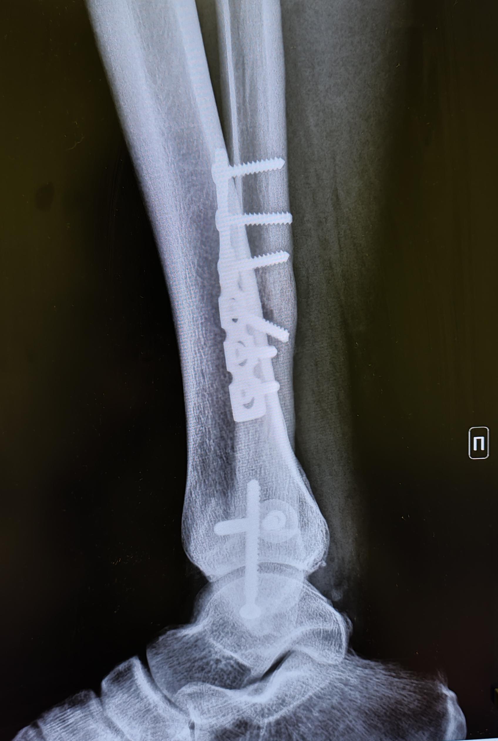 Не сросшийся оскольчатый перелом - Моё, Медицина, Армия, Операция, Перелом, Рентген, Травма, Травматология, Призыв, Призыв в армию, Лечение, Длиннопост