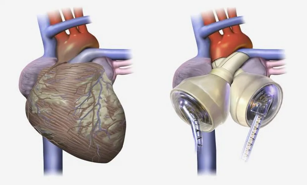 Artificial heart transplant - My, The science, Scientists, Research, Heart, Artificial, Artificial heart, Technologies, Heart transplant, Transfer, Operation, Inventions, A life, Longpost