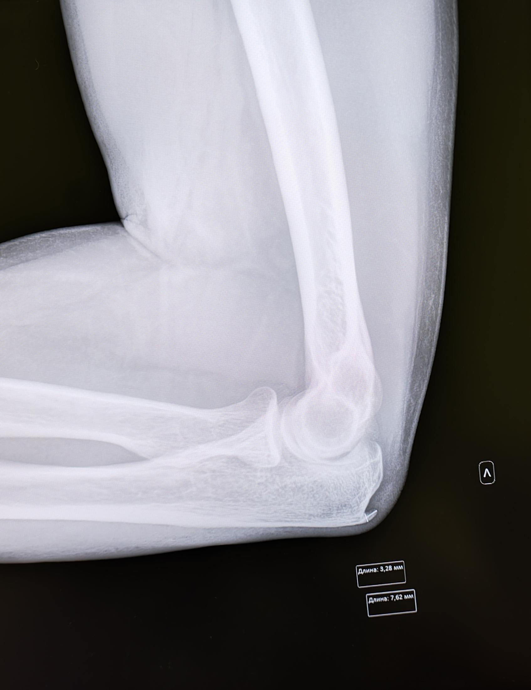 Elbow spur - My, The medicine, Army, Health, Military enlistment office, Spur, Joints, X-ray, Radiology, Orthopedics, Surgery, Conscripts, Bones, Longpost