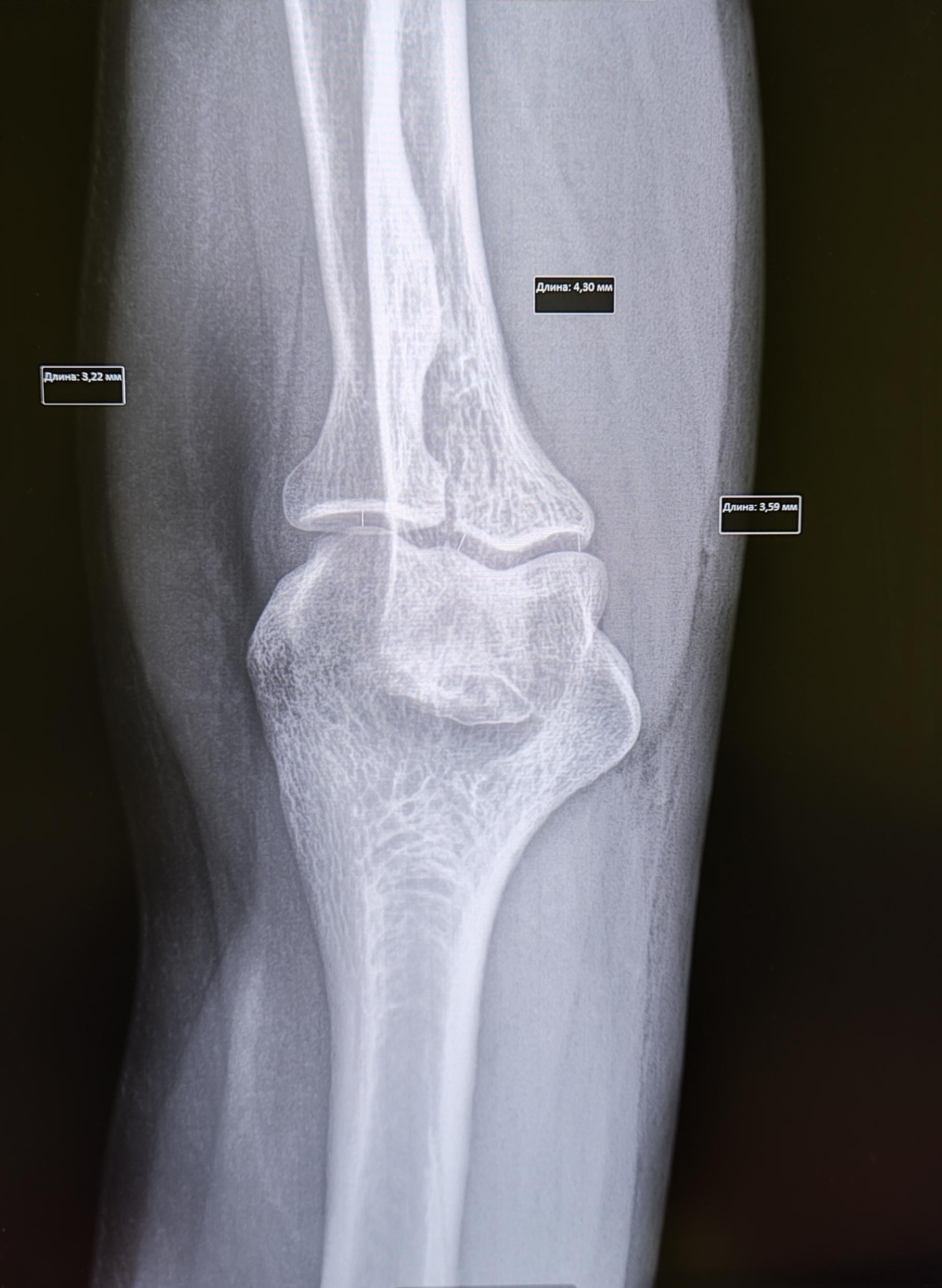 Elbow spur - My, The medicine, Army, Health, Military enlistment office, Spur, Joints, X-ray, Radiology, Orthopedics, Surgery, Conscripts, Bones, Longpost