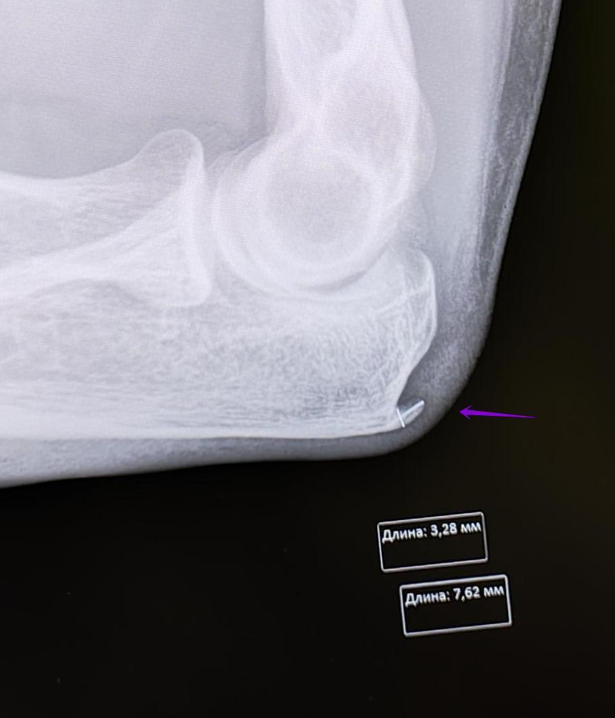 Elbow spur - My, The medicine, Army, Health, Military enlistment office, Spur, Joints, X-ray, Radiology, Orthopedics, Surgery, Conscripts, Bones, Longpost