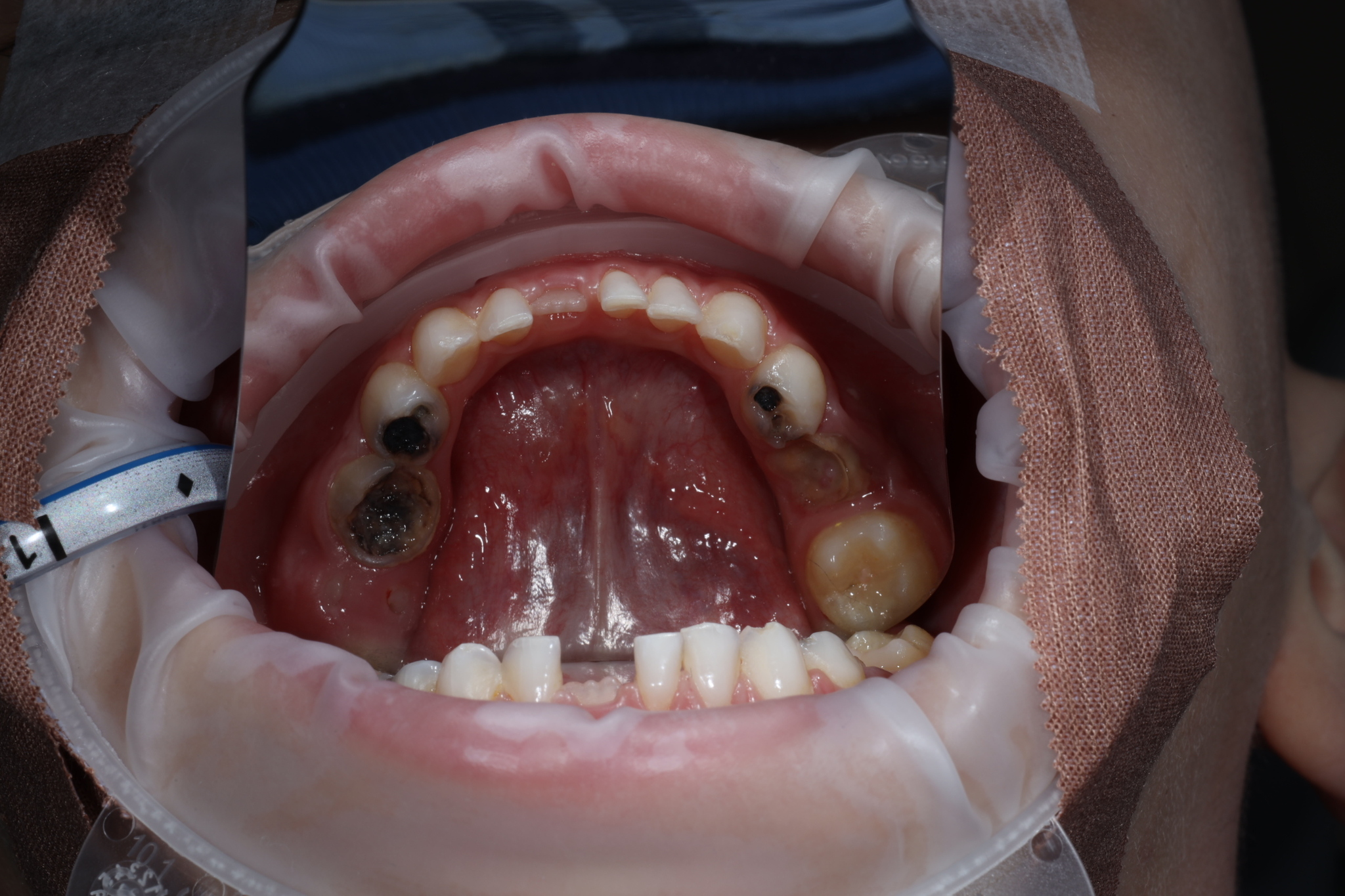 Post #12133220 - My, Dentistry, Children, Teeth, Baby teeth, Longpost