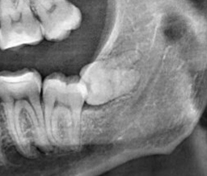 Почему их называют зубами мудрости, это же зубы тупости - Юмор, Рентген, Зыбы, Зуб мудрости, Зубы