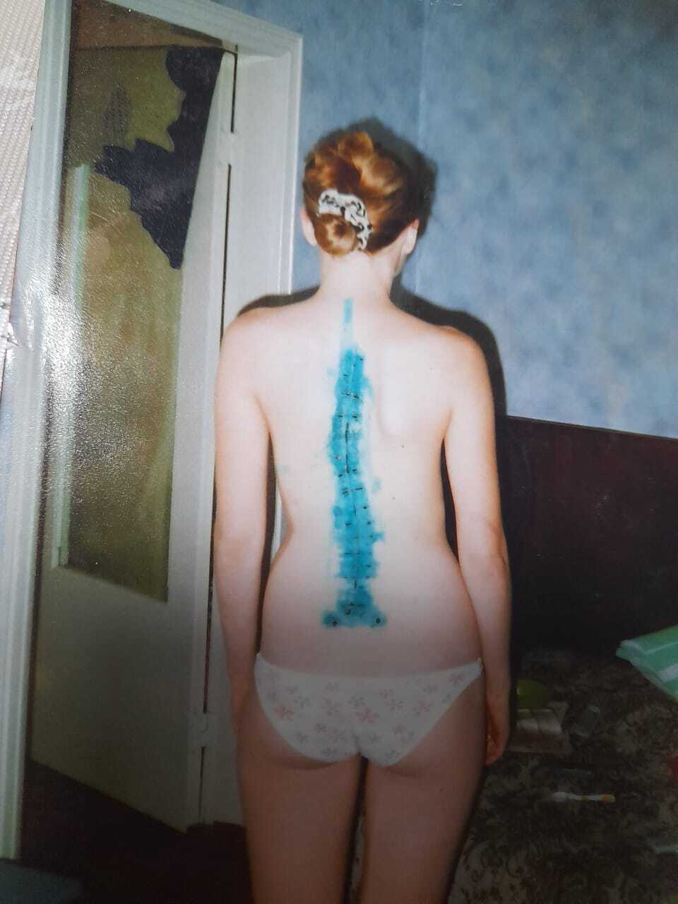 I'm No Longer the Iron Lady, or How to Treat Scoliosis Without Registration - My, Scoliosis, Operation, Recovery, Mat, Longpost