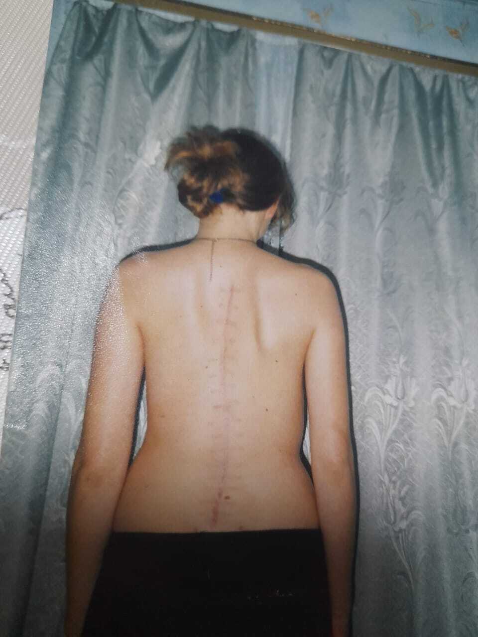 I'm No Longer the Iron Lady, or How to Treat Scoliosis Without Registration - My, Scoliosis, Operation, Recovery, Mat, Longpost