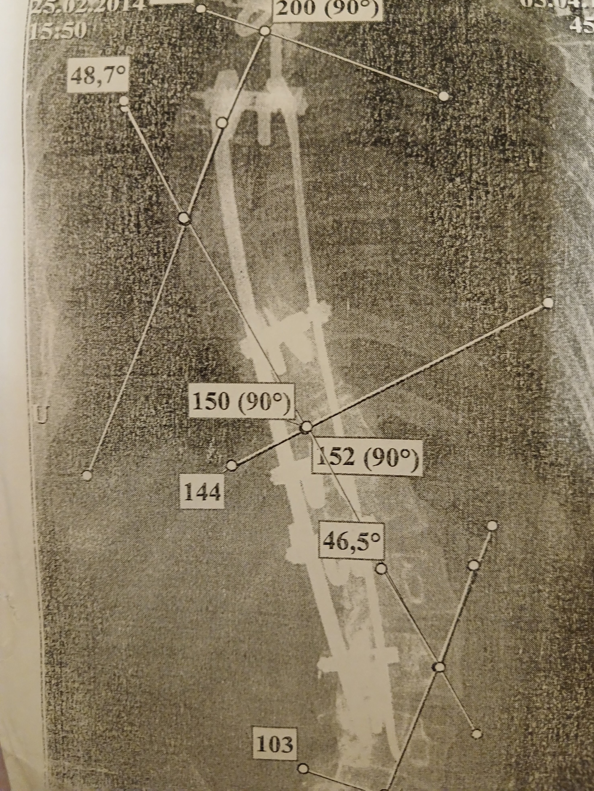 I'm No Longer the Iron Lady, or How to Treat Scoliosis Without Registration - My, Scoliosis, Operation, Recovery, Mat, Longpost