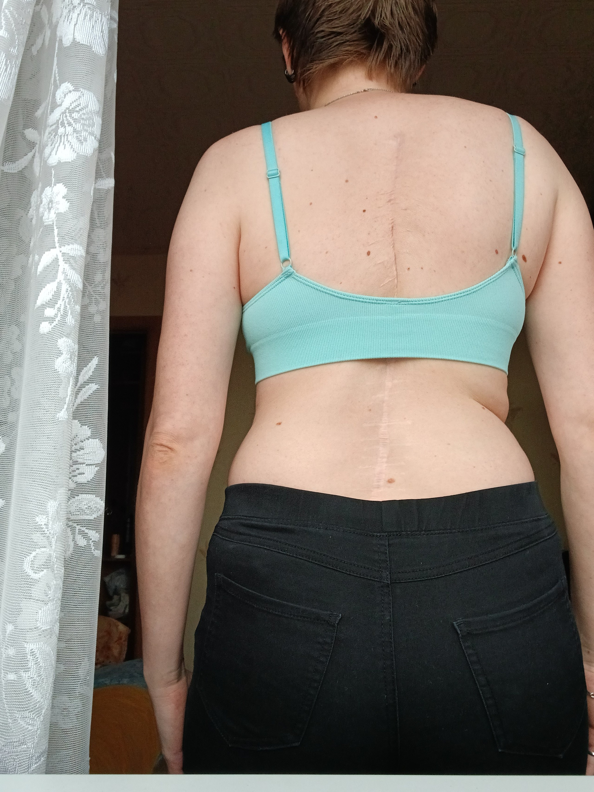 I'm No Longer the Iron Lady, or How to Treat Scoliosis Without Registration - My, Scoliosis, Operation, Recovery, Mat, Longpost