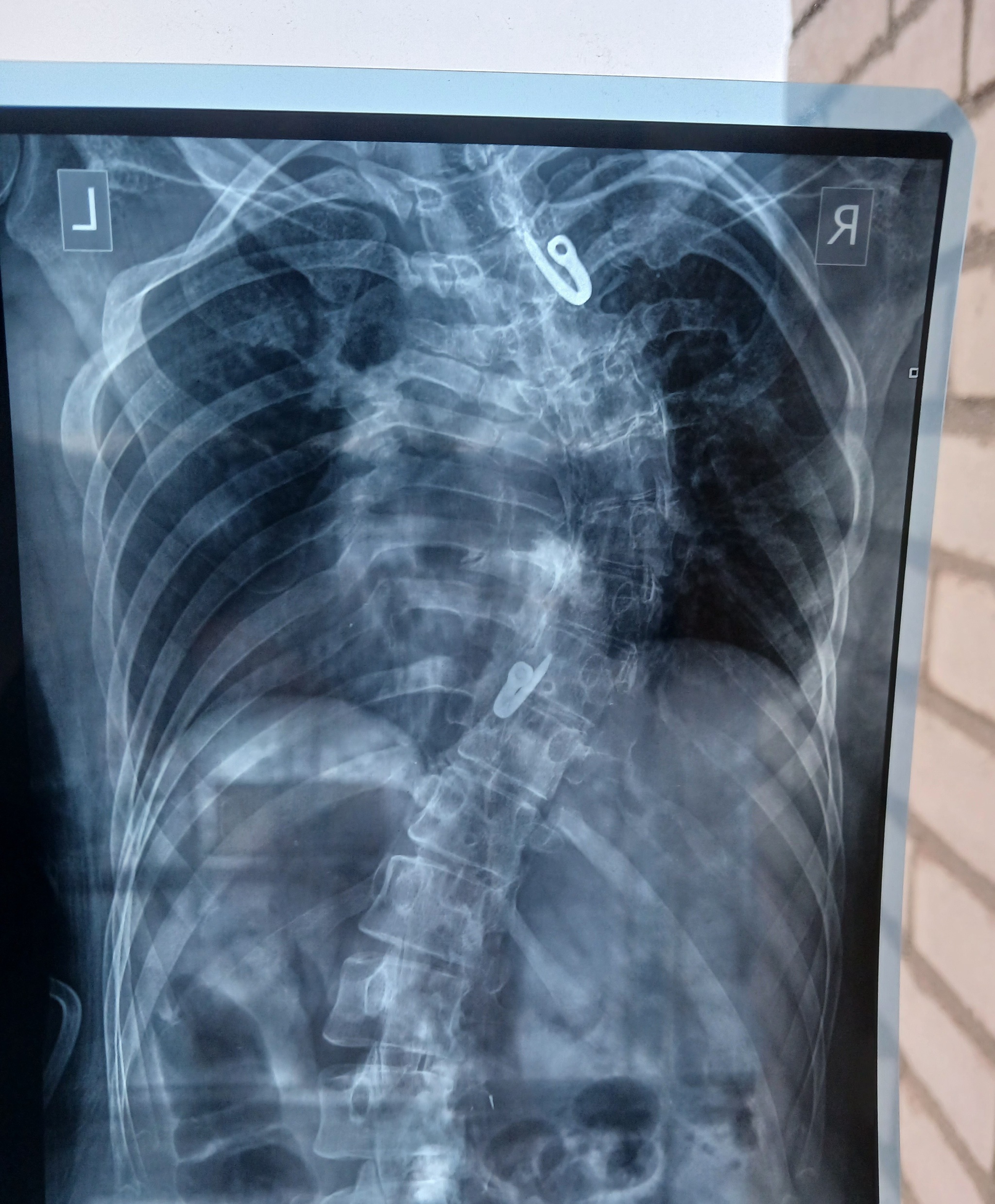 I'm No Longer the Iron Lady, or How to Treat Scoliosis Without Registration - My, Scoliosis, Operation, Recovery, Mat, Longpost