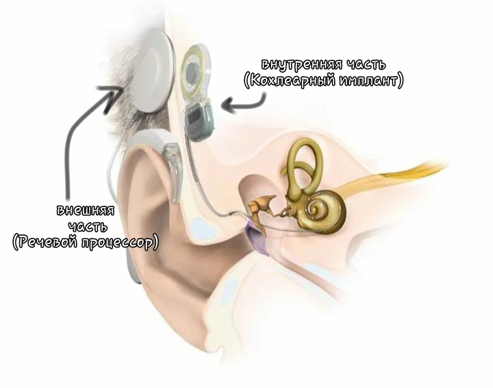 Кто я? Что за КИ? - Кохлеарная имплантация, Инвалид, Слабослышащие, Никогда не сдавайся, Протез, Длиннопост, Все будет хорошо, Глухота, Импланты