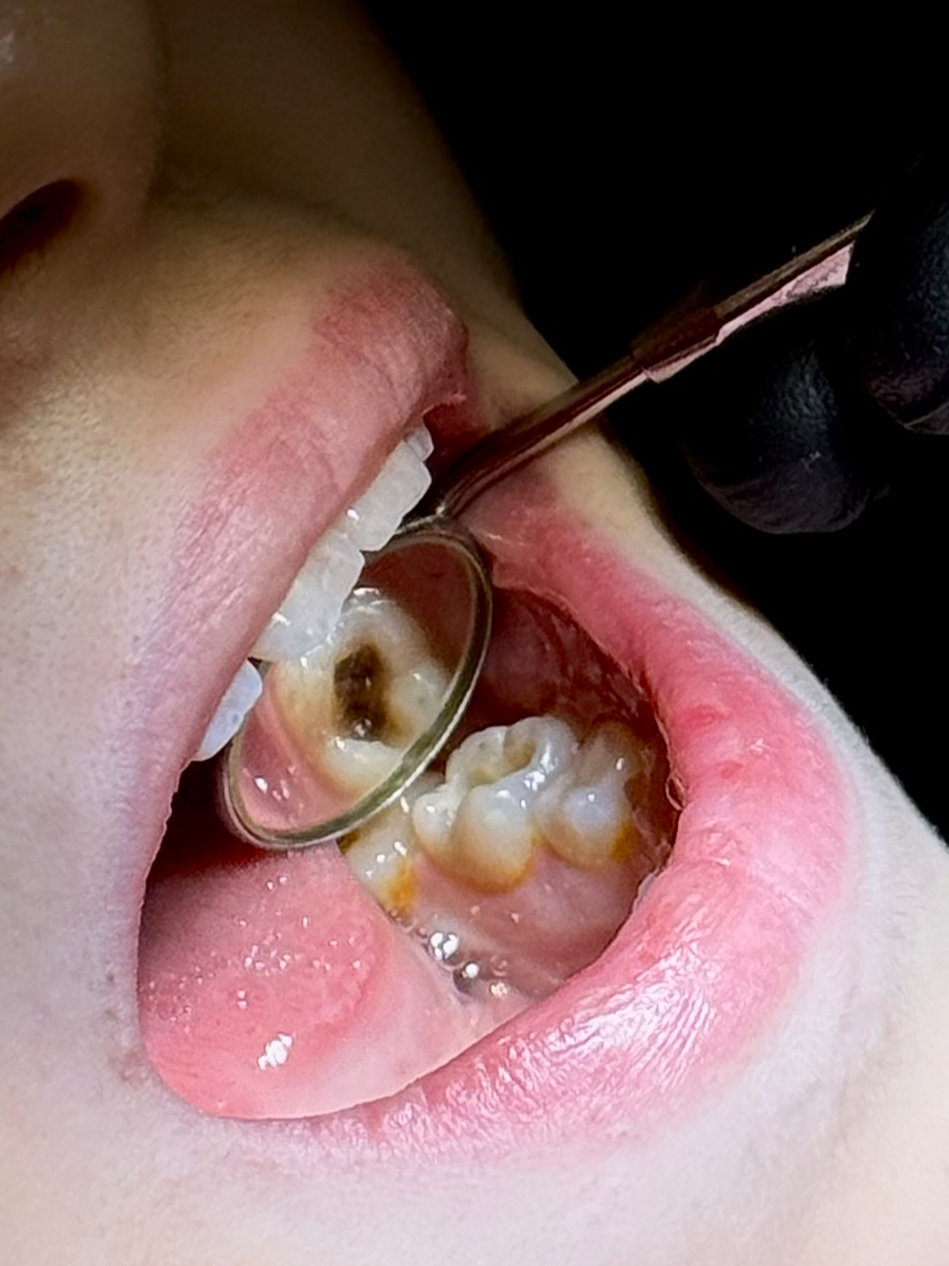 And it doesn't even hurt her. - My, Dentistry, Treatment, Teeth, Longpost