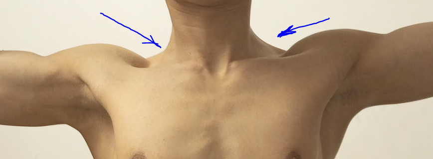 Trapezius muscle - My, The medicine, Question, Ask Peekaboo, Scoliosis, Muscle, Problem, Need advice, Consultation, Training apparatus, PHYSICAL THERAPY