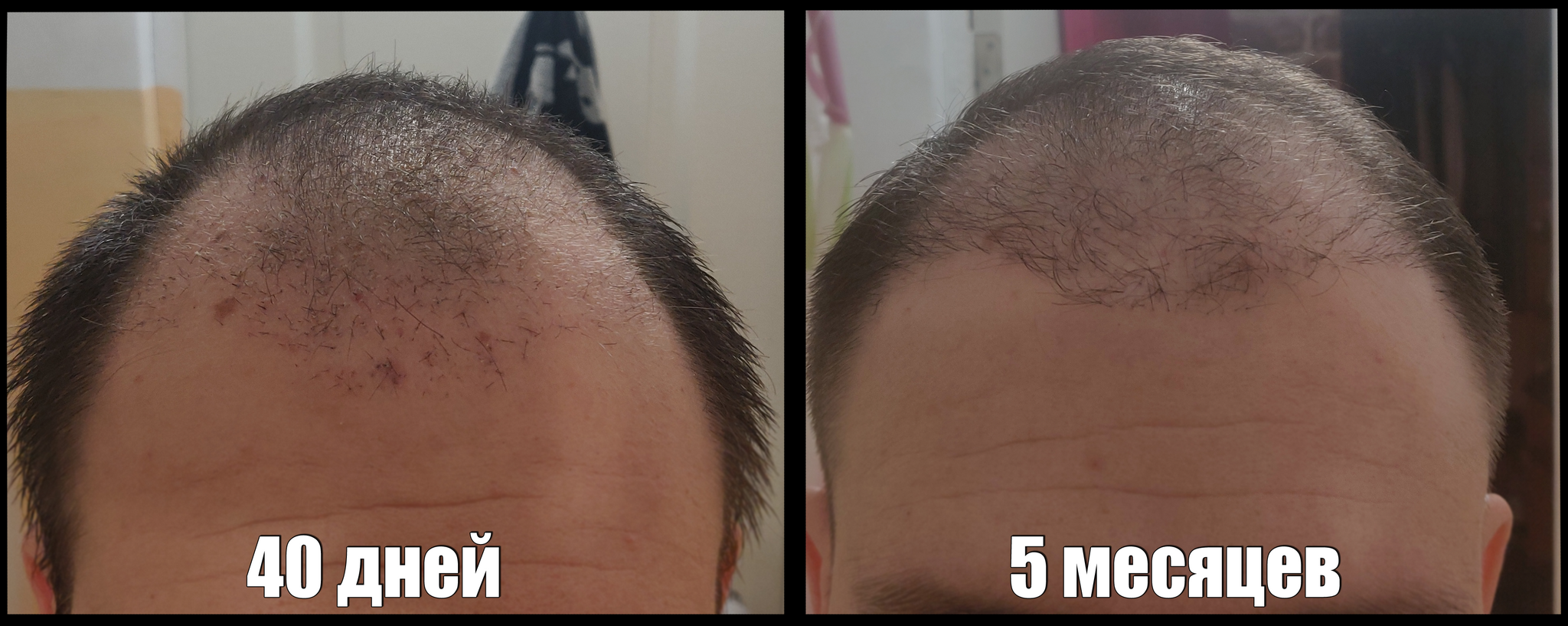 Had a hair transplant in Vladivostok part 3 | 5 months have passed - My, Alopecia, Hair Transplant, Baldness, Hair, Operation, Longpost, Report