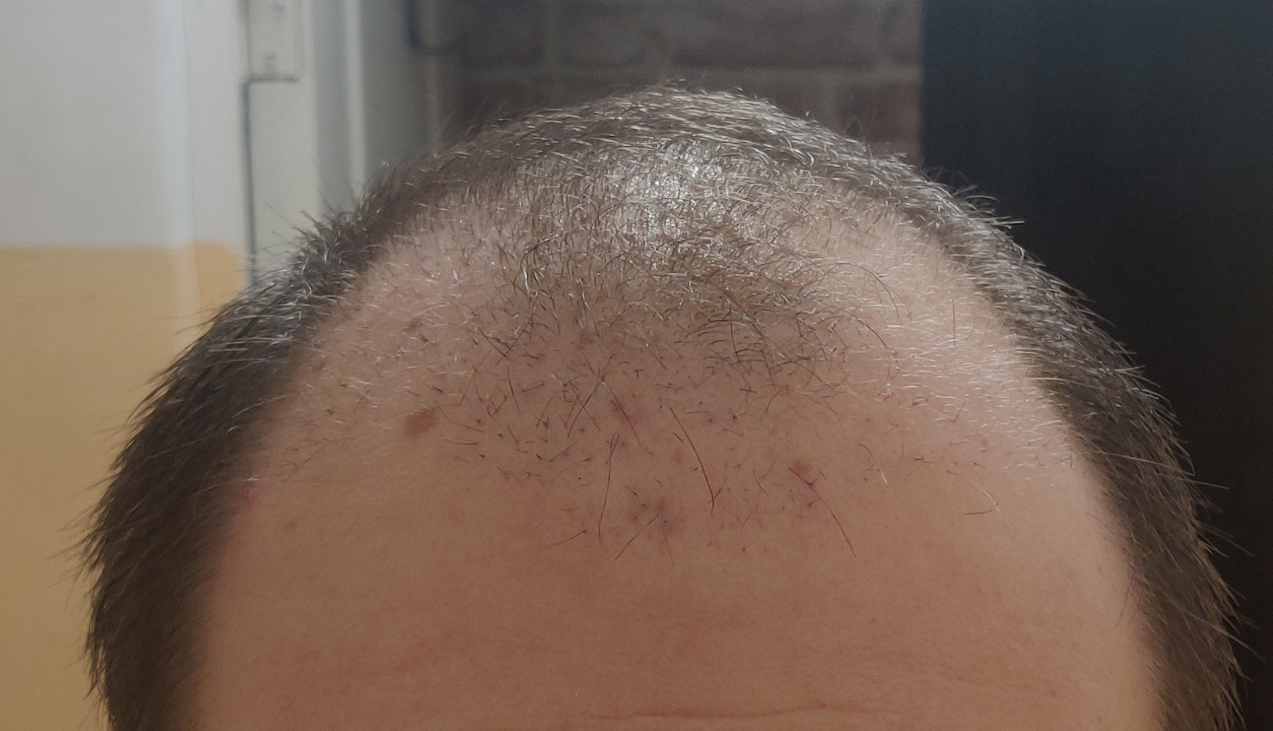 Had a hair transplant in Vladivostok part 3 | 5 months have passed - My, Alopecia, Hair Transplant, Baldness, Hair, Operation, Longpost, Report