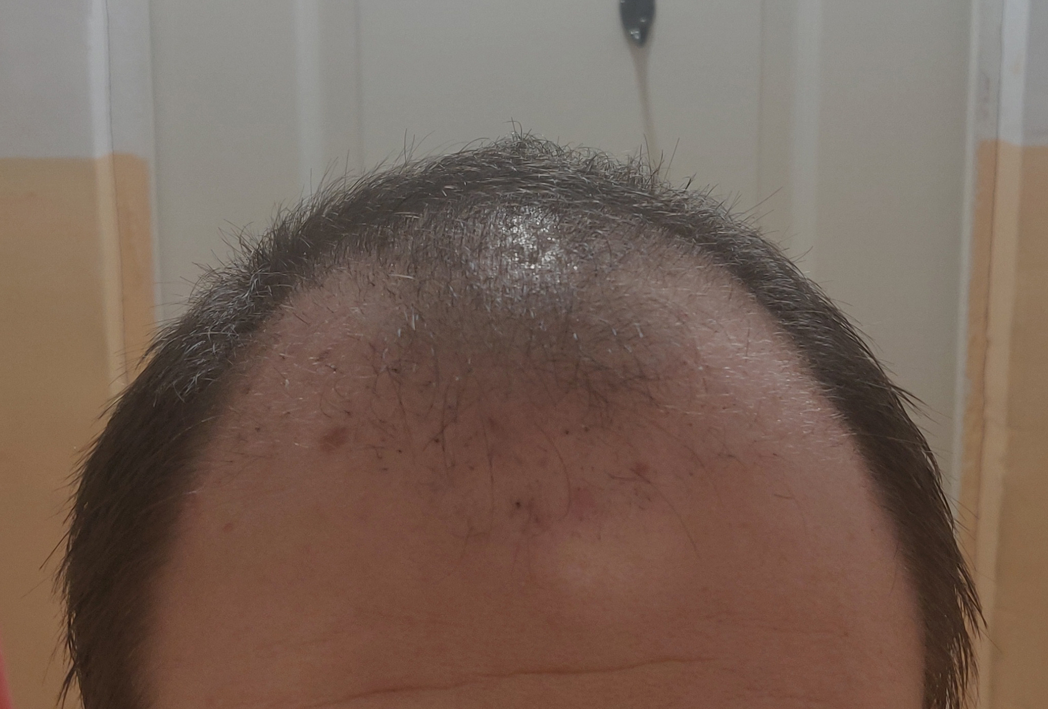 Had a hair transplant in Vladivostok part 3 | 5 months have passed - My, Alopecia, Hair Transplant, Baldness, Hair, Operation, Longpost, Report