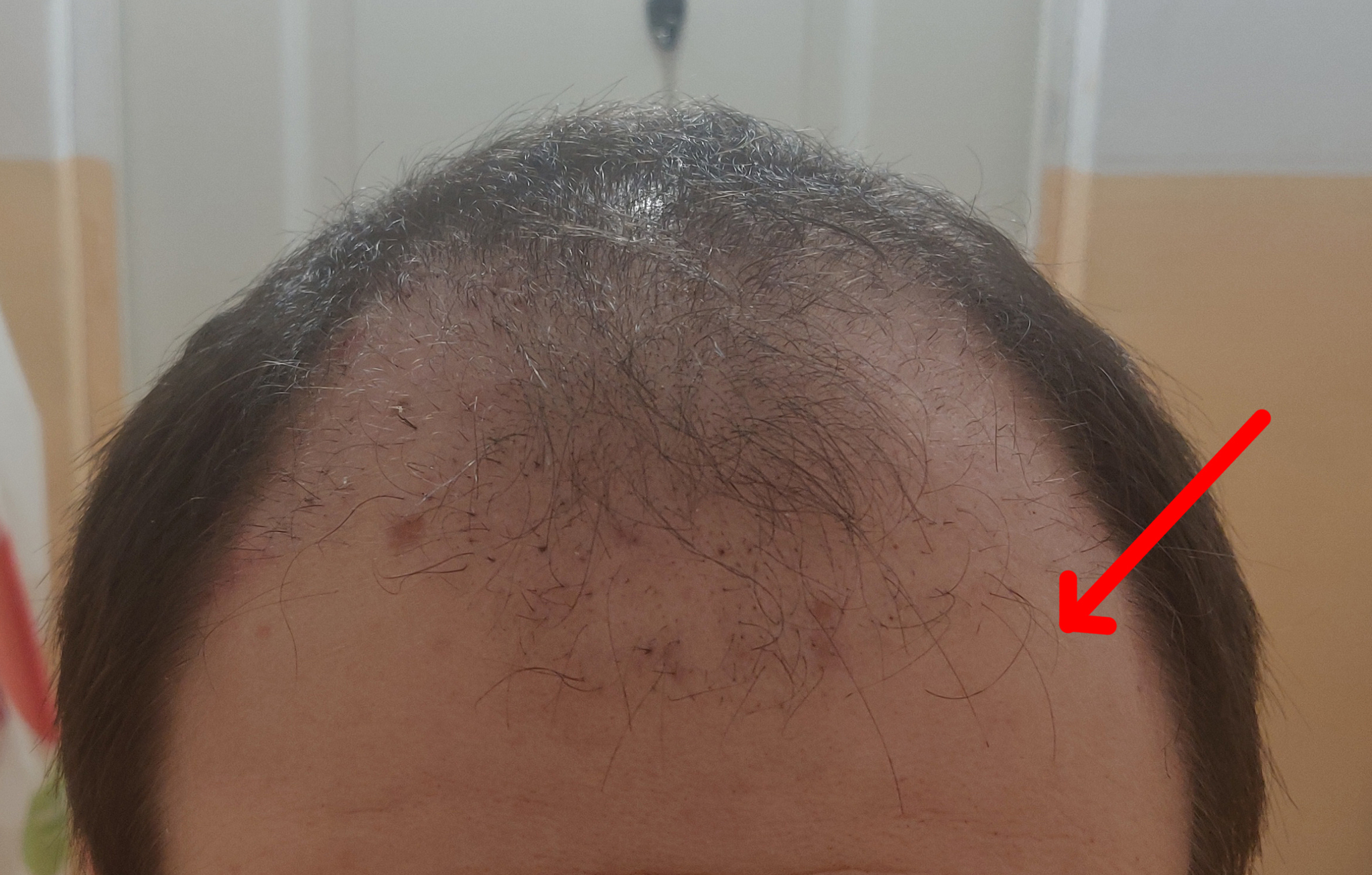 Had a hair transplant in Vladivostok part 3 | 5 months have passed - My, Alopecia, Hair Transplant, Baldness, Hair, Operation, Longpost, Report