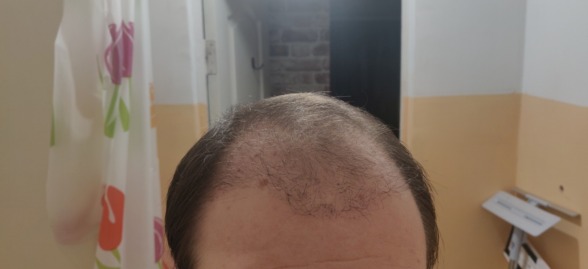 Had a hair transplant in Vladivostok part 3 | 5 months have passed - My, Alopecia, Hair Transplant, Baldness, Hair, Operation, Longpost, Report