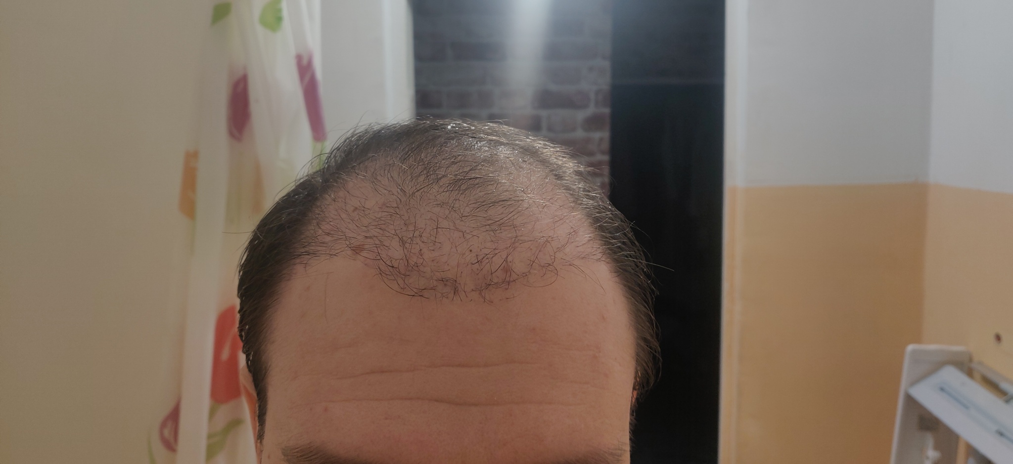 Had a hair transplant in Vladivostok part 3 | 5 months have passed - My, Alopecia, Hair Transplant, Baldness, Hair, Operation, Longpost, Report