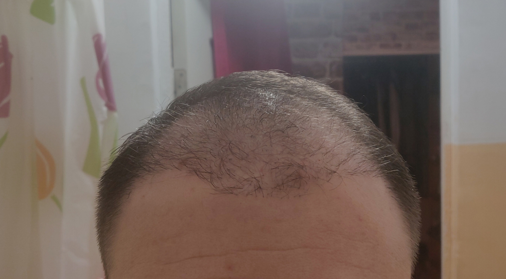 Had a hair transplant in Vladivostok part 3 | 5 months have passed - My, Alopecia, Hair Transplant, Baldness, Hair, Operation, Longpost, Report