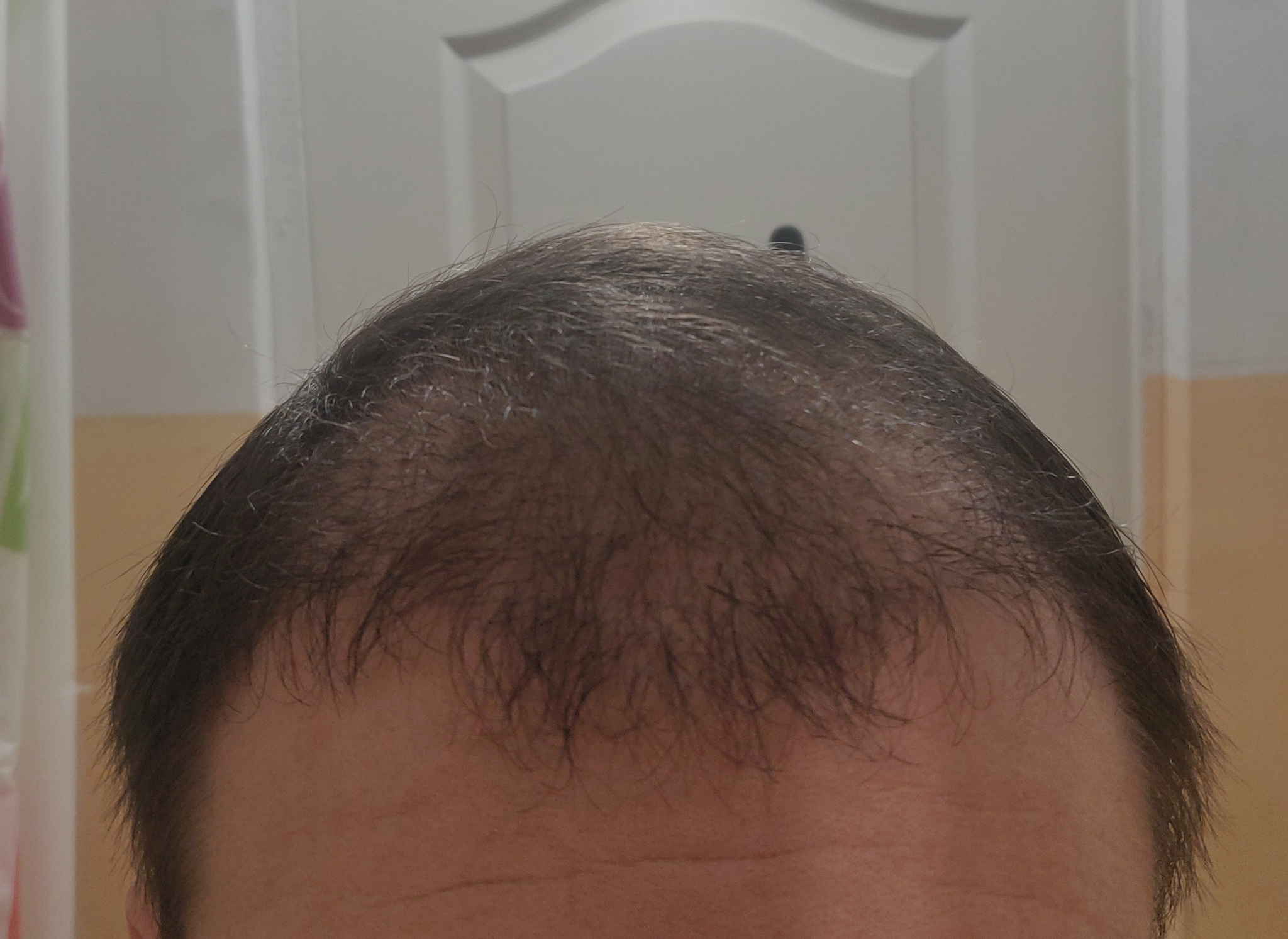 Had a hair transplant in Vladivostok part 3 | 5 months have passed - My, Alopecia, Hair Transplant, Baldness, Hair, Operation, Longpost, Report